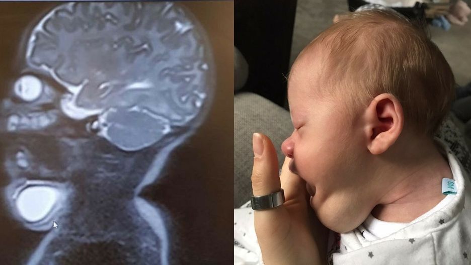 Dziecko urodziło się z ogromnym guzem limfatycznym