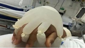 "Ręka Boga". Pielęgniarki napełniają rękawiczki ciepłą wodą, żeby pacjenci nie czuli sie samotni