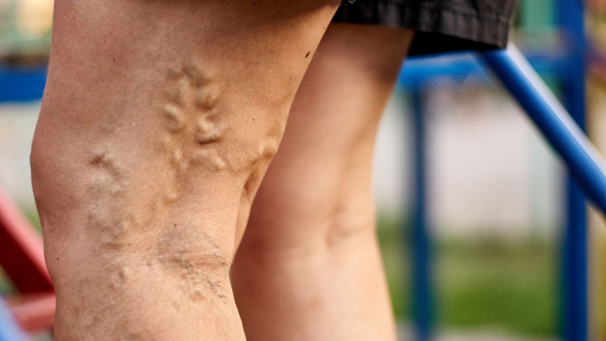 Stripping jest tradycyjną, chirurgiczną metodą leczenia żylaków.