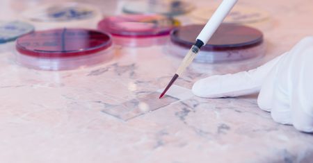 Diagnostyka białaczek - morfologia krwi, biopsja szpiku, badania cytogenetyczne