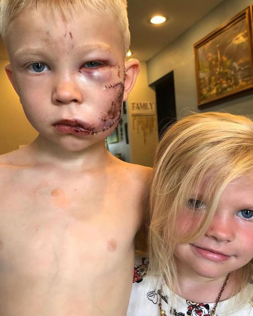 Bridger wraz z siostrą Nicole po ataku psa