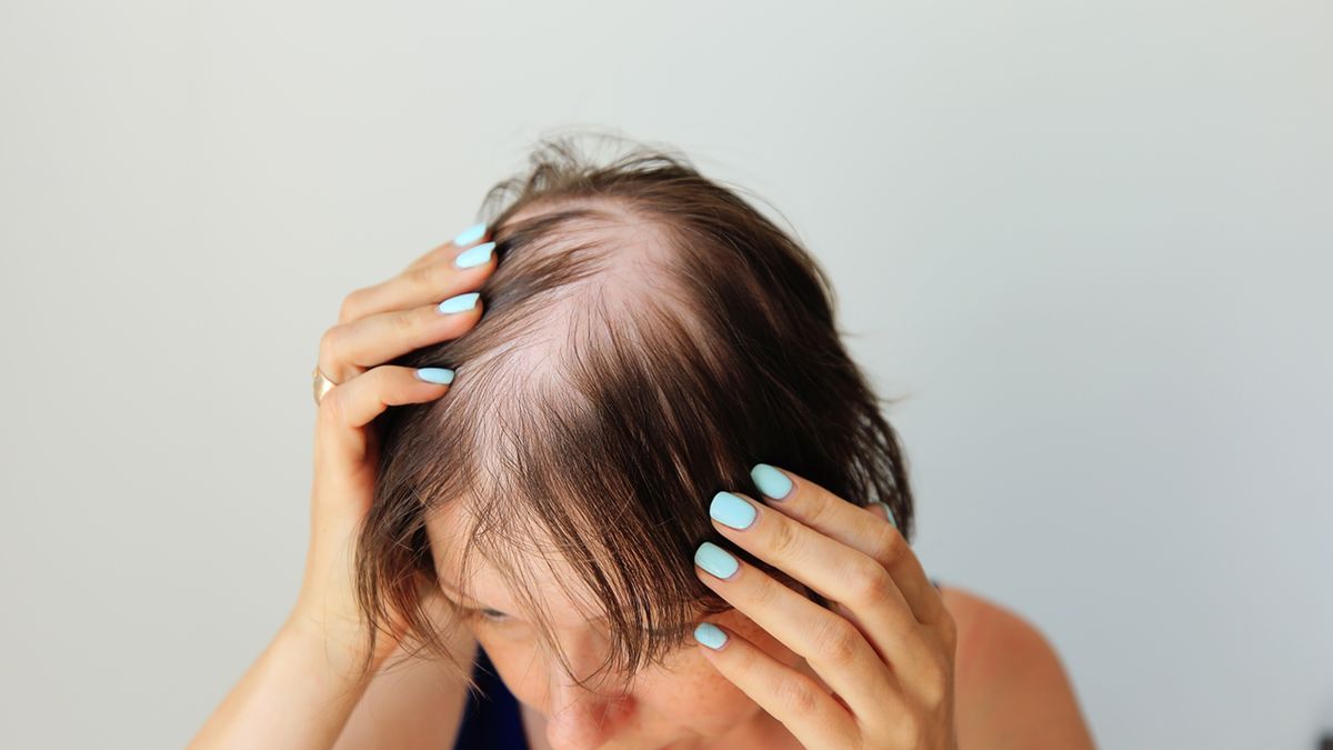 Łysienie u kobiet może mieć wiele różnych przyczyn.