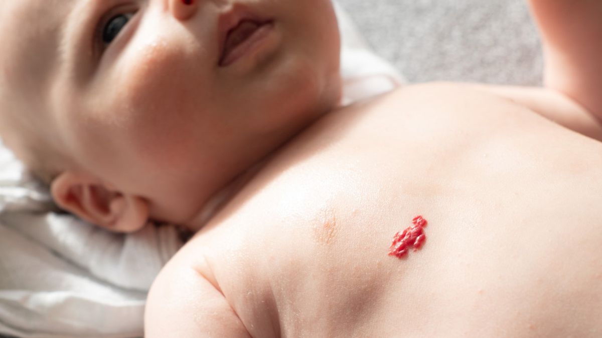 Naczyniak u noworodka