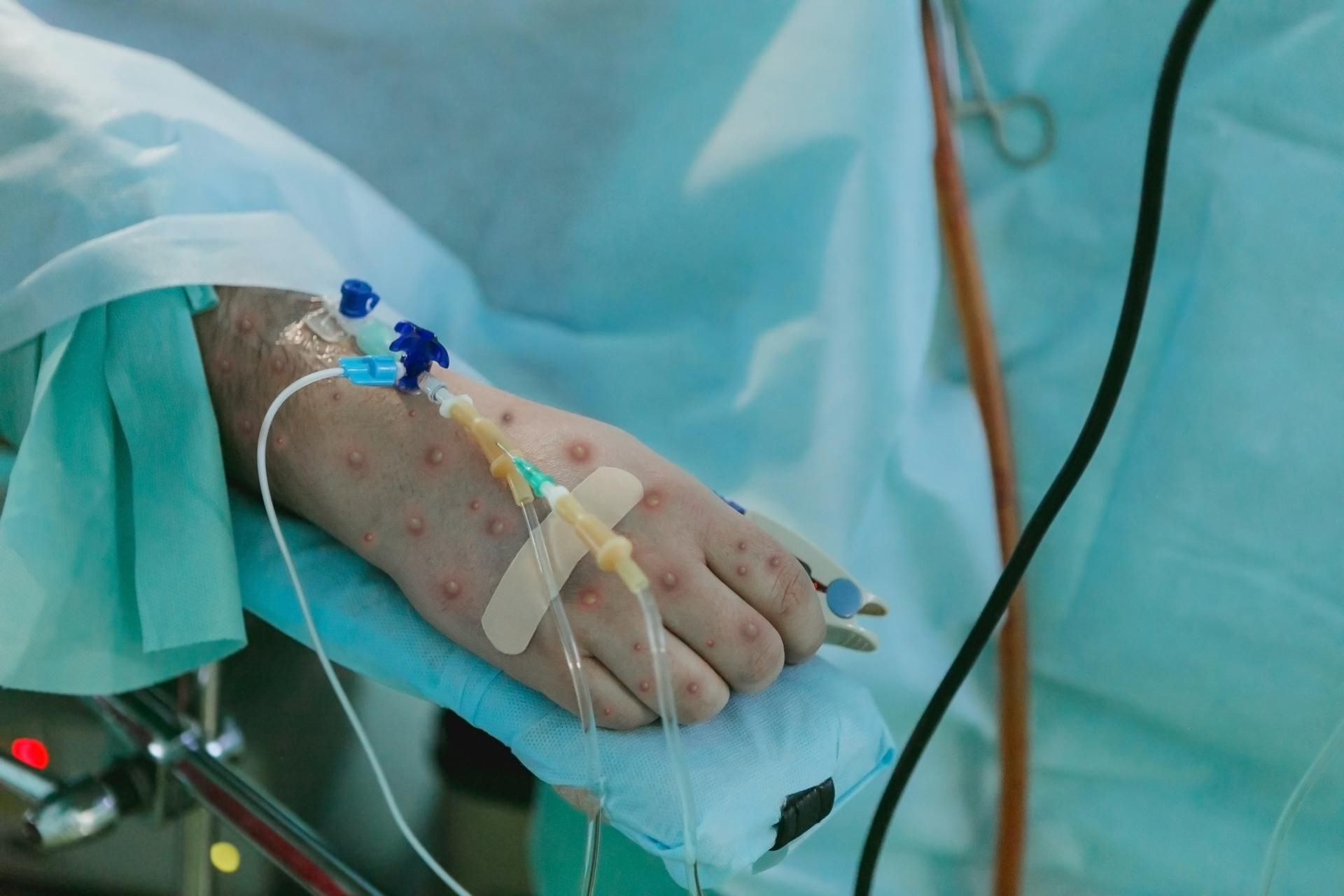 Wirus mpox rozprzestrzenia się błyskawicznie