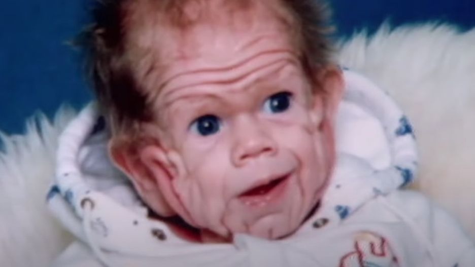 Byli w szoku gdy się urodził. Tak wygląda 30 lat później