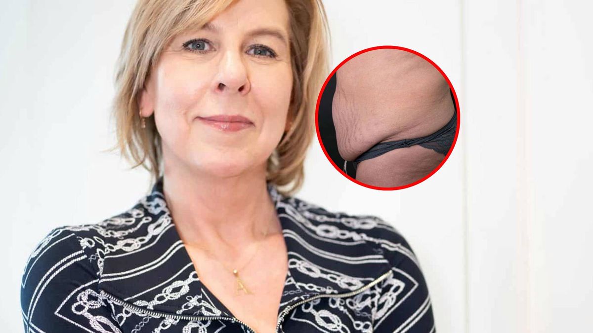 Schudła 25 kg i nie może patrzeć na swój brzuch. Lekarz: jakość życia pacjentki spada