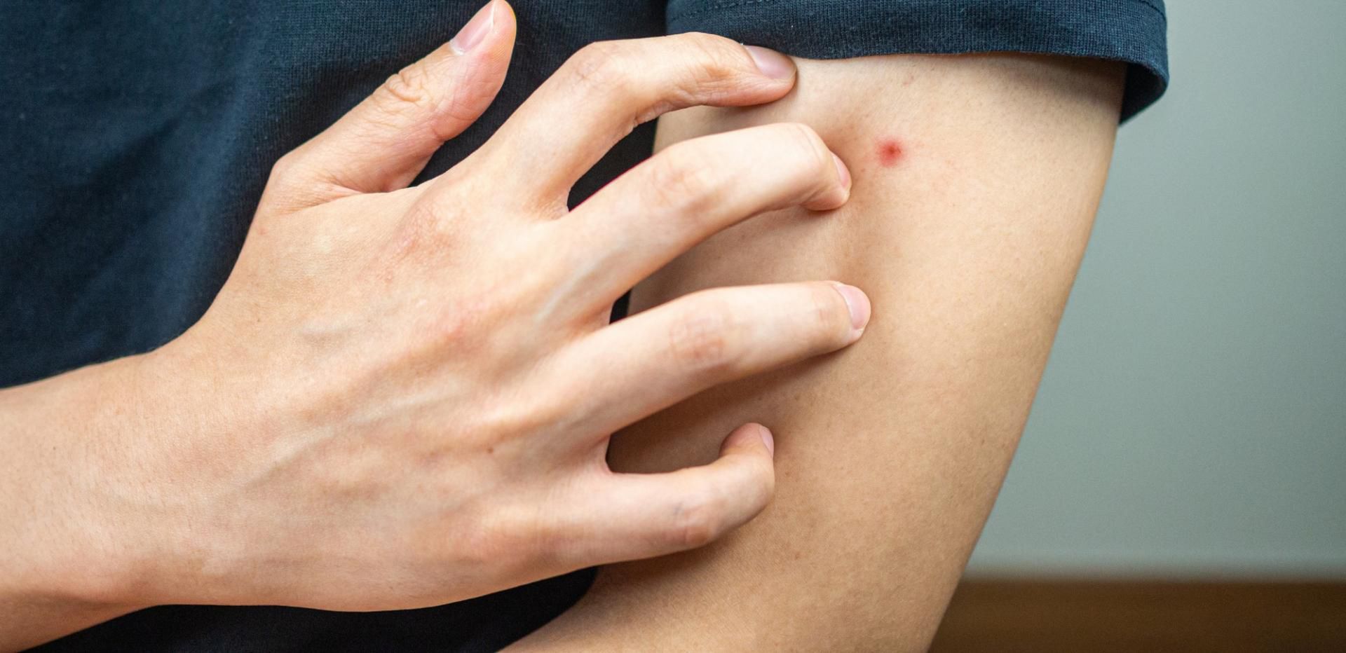 O ukąszeniu meszki może świadczyć niewielka ranka na skórze