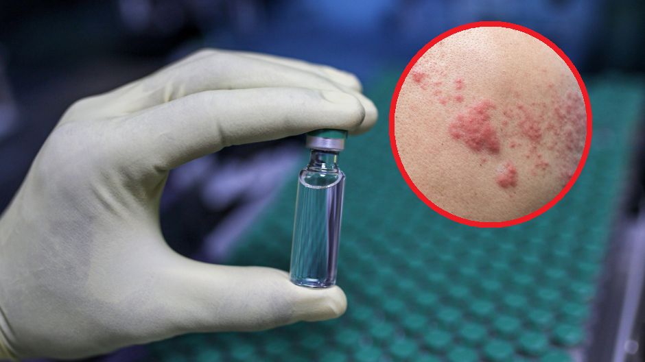 Ten wirus prowadzi do półpaśca. 99 proc. osób po 50. r.ż. jest jego nosicielem