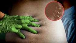 ''Palma'' na skórze. To sygnał, że na ratunek dla wątroby może być za późno 