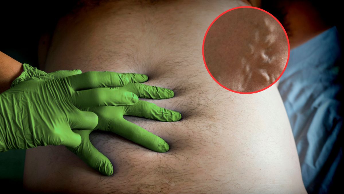 Marskość wątroby to poważne, choć często niedające wielu objawów schorzenie