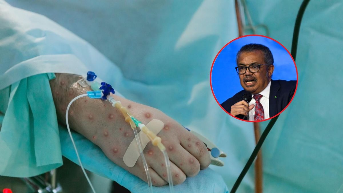 WHO odwołuje globalne zagrożenie małpią ospą