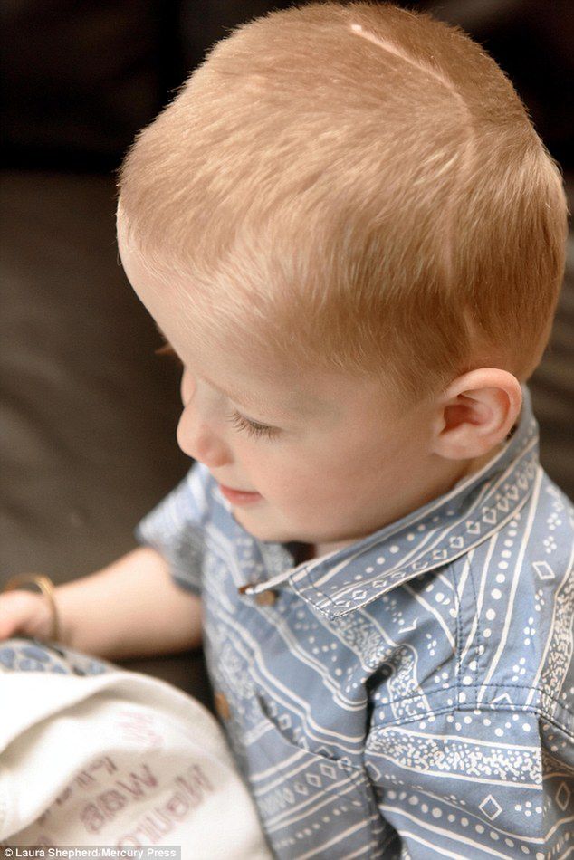 Harry z pooperacyjną blizną na głowie/ DailyMail