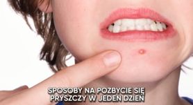 Jak zlikwidować pryszcze w jeden dzień? (WIDEO)