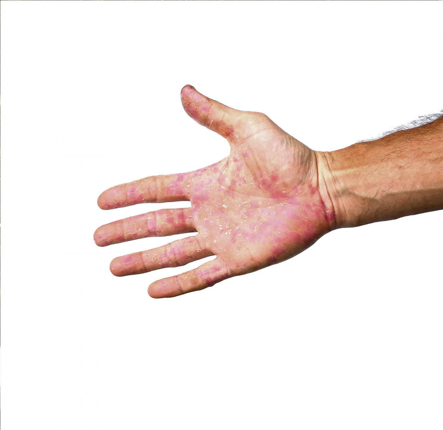 Rumień wielopostaciowy objawia się zmianami o typie rumienia oraz pęcherzyków