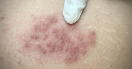 Grozi nam epidemia? Trafiają do szpitala z ciężkimi powikłaniami