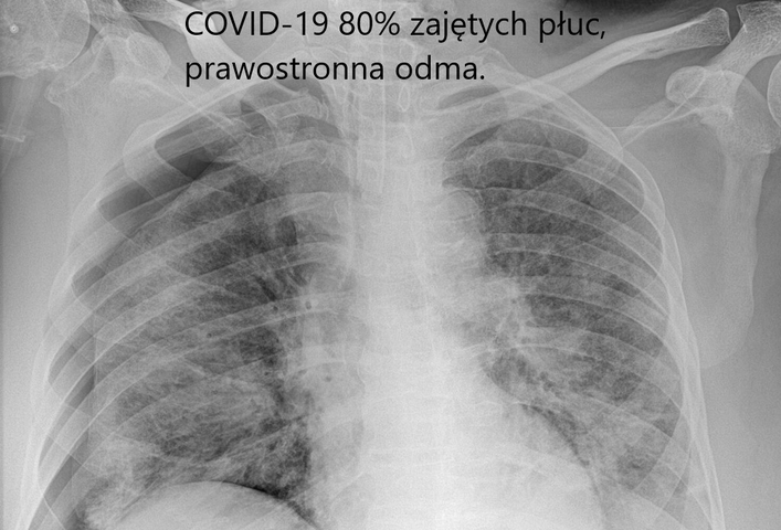 COVID-19 niszczy płuca