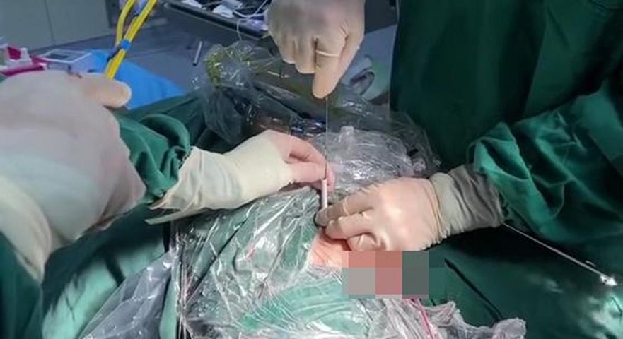 Lekarze usunęli kabel z pęcherza dziecka