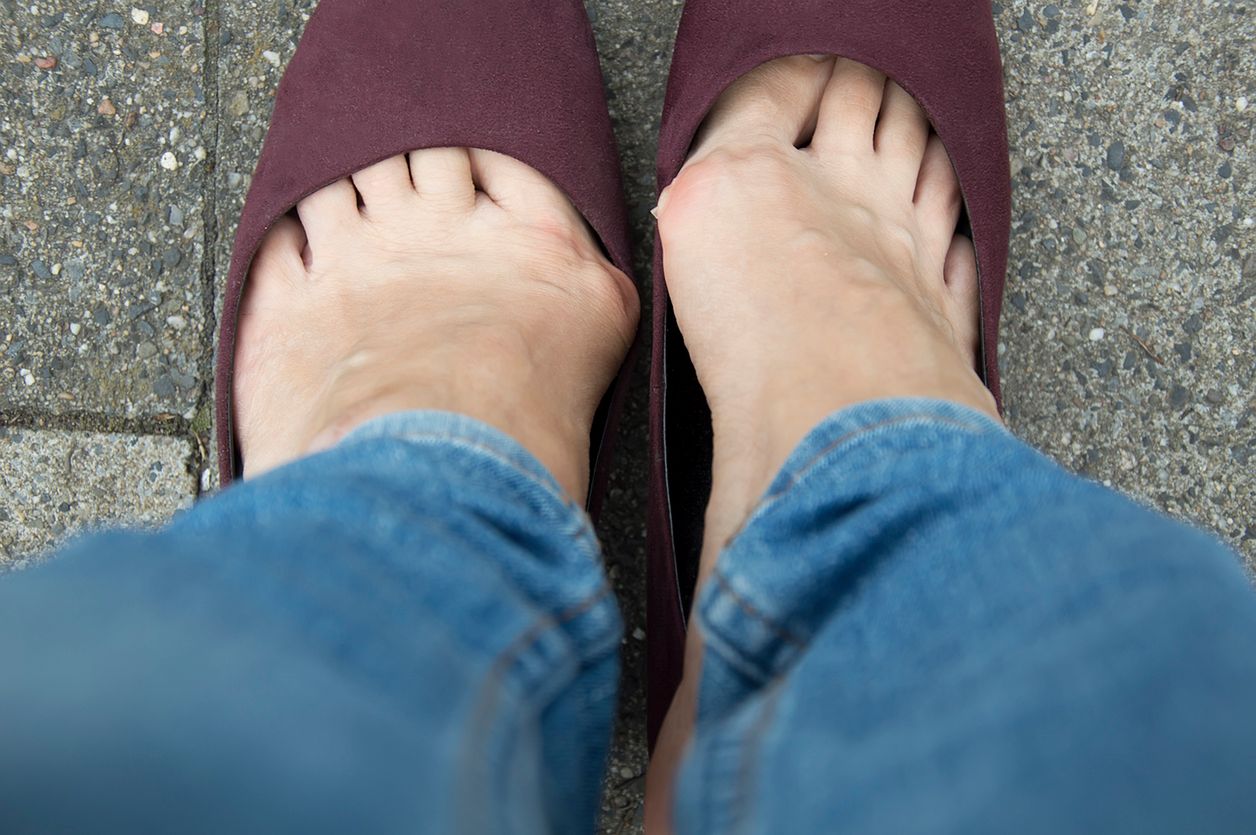 Haluksy to deformacja stawów stóp