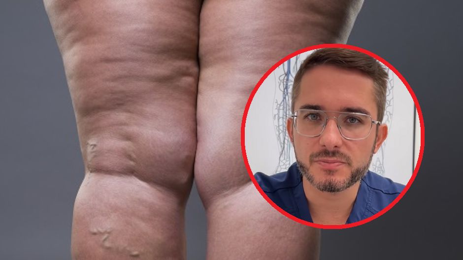 "Nie daj sobie wmówić, że taka twoja uroda". Prof. Paluch ostrzega przed powszechnym schorzeniem