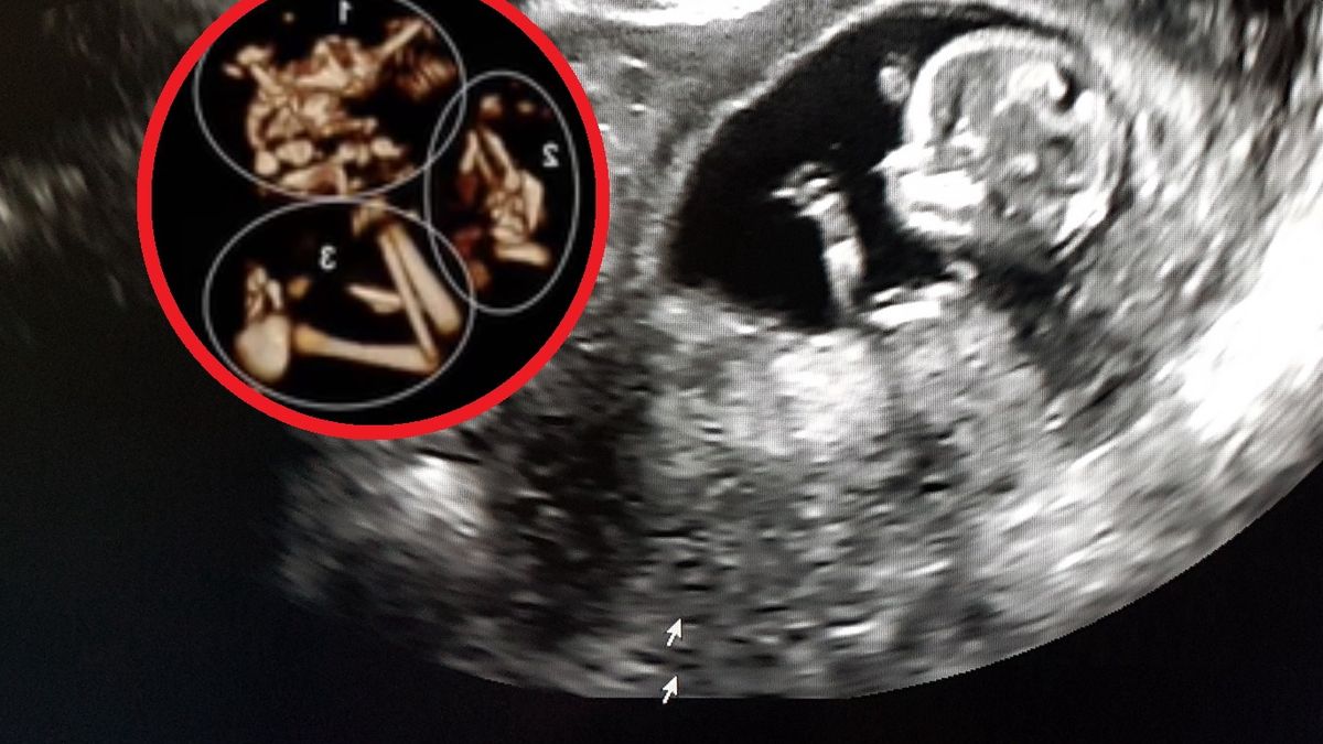 Niepokojący szczegół zwrócił uwagę podczas USG. Rodzice musieli podjąć trudną decyzję