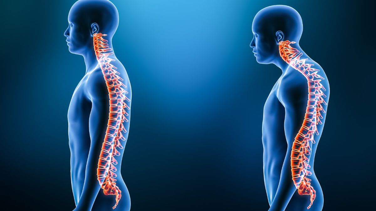 Nadmierna kifoza to powszechny problem zdrowotny zarówno wśród osób młodych, jak i starszych.