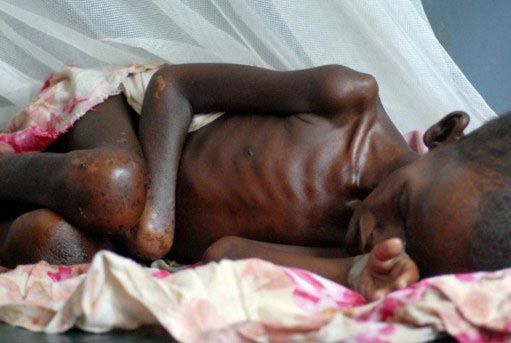 Katastrofa w Somalii - epidemia zabiła już tysiące ludzi