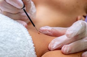 Diatermia – rodzaje, efekty i przeciwwskazania