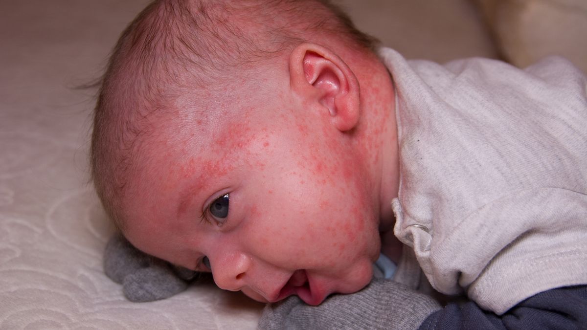 Uczulenie u noworodka wynika z nieprawidłowej pracy układu odpornościowego