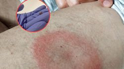 Kleszcze w natarciu. NFZ opublikował alarmujące dane