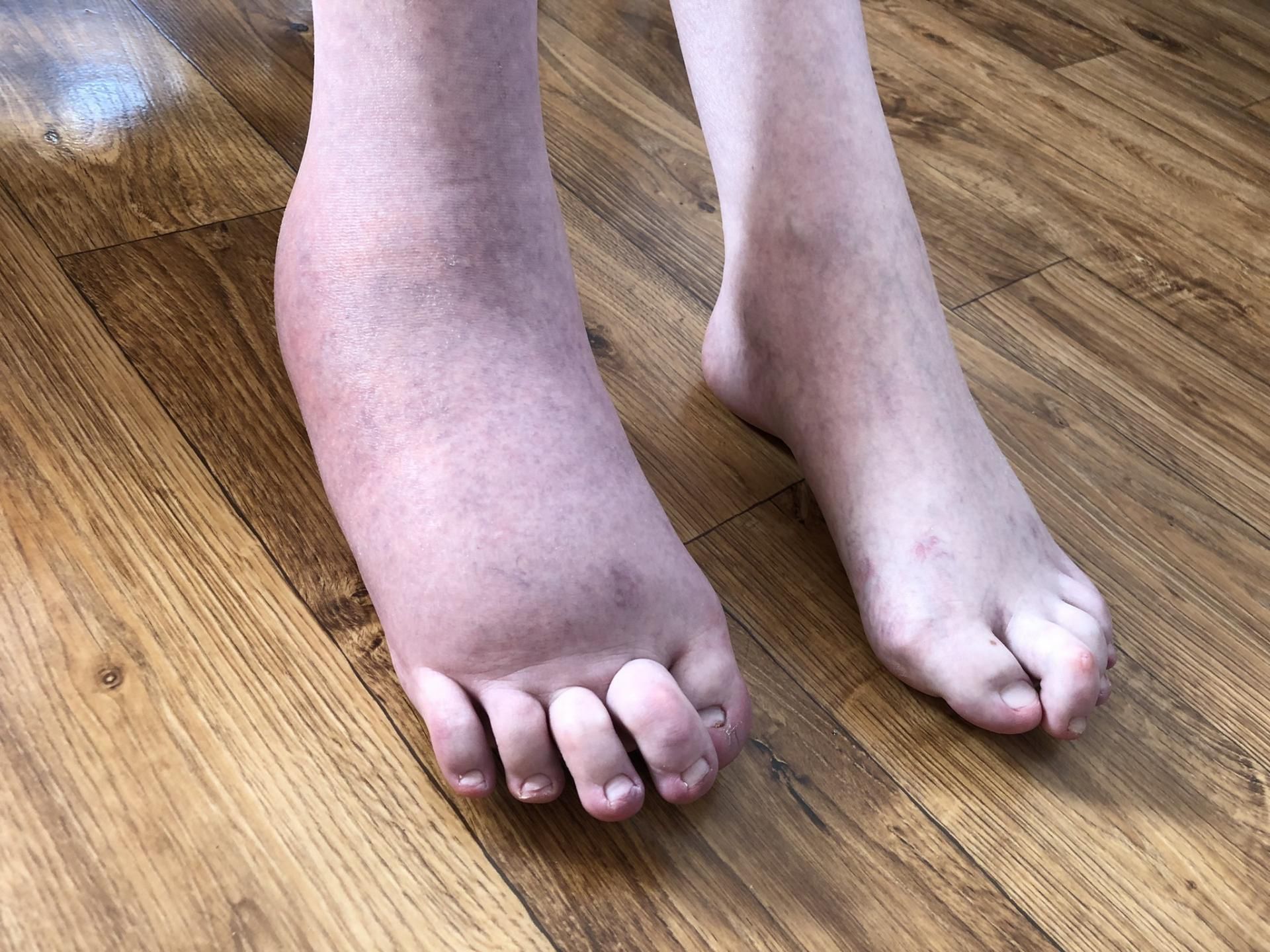 Palce u stóp osoby z FOP