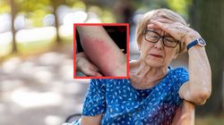 Znaczący wzrost zakażeń w Polsce. Objawy to zmęczenie, zmiana skórna