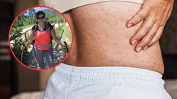 Widać ją na skórze, ale niszczy serce i psychikę. "Straciłam co najmniej 10 lat życia"