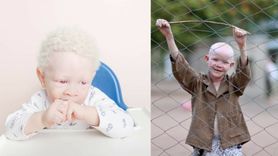 Ich życie warte jest 75 tys. dolarów. Albinosi każdego dnia walczą o życie