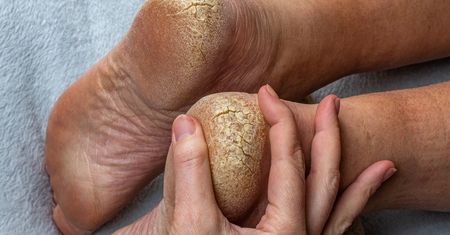 Poważny niedobór. Główny objaw zauważysz na piętach