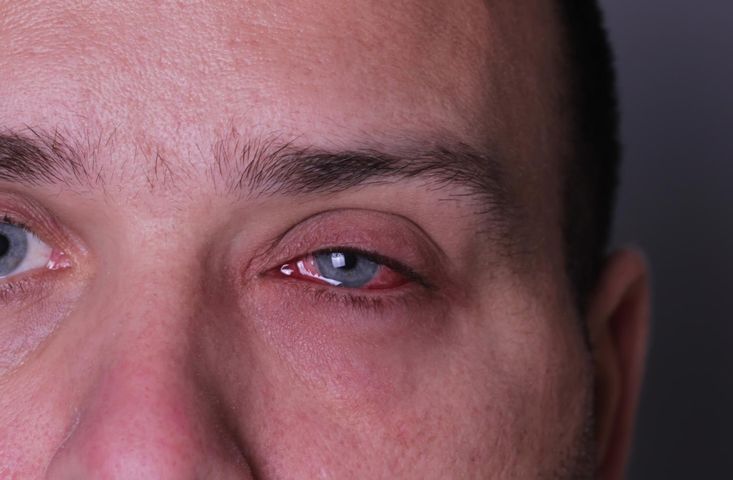 Boreliozę można dostrzec w oczach. Mało znane objawy choroby przenoszonej przez kleszcze