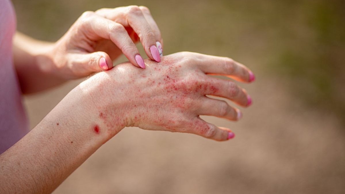 Atopowe zapalenie skóry jest niezwykle powszechną przewlekłą, zapalną, ale co ważne niezakaźną chorobą skórną.
