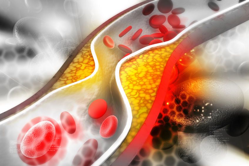 Tętnica zatkana przez cholesterol