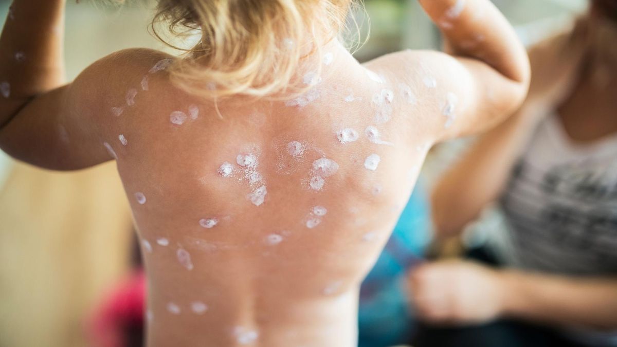 Czy naprawdę ospę trzeba wyleżeć?