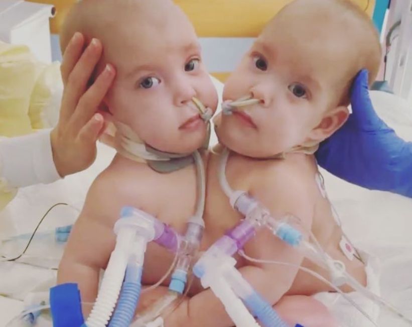 Długo trzeba było czekać, żeby operacja rozdzielenia mogła się odbyć