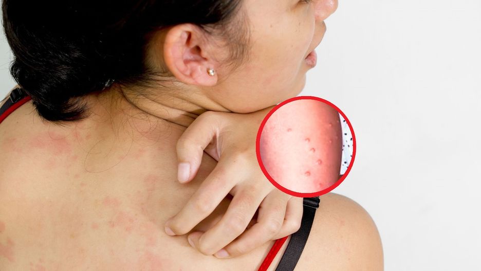 Basenowa wysypka. "Synek męczy się z tym od trzech lat"