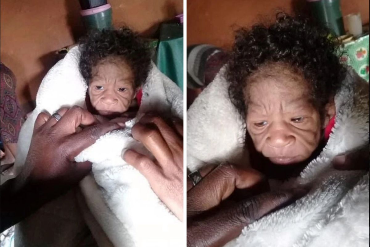 Niemowlę wygląda jak starzec. Urodziło się z rzadką chorobą genetyczną