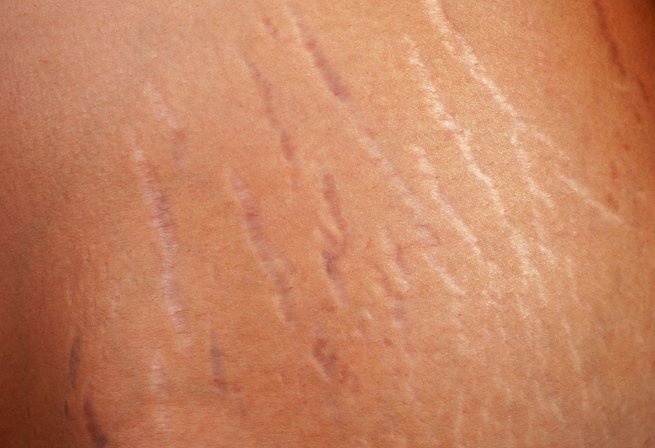 Jak nie dopuścić do pojawienia się rozstępów?