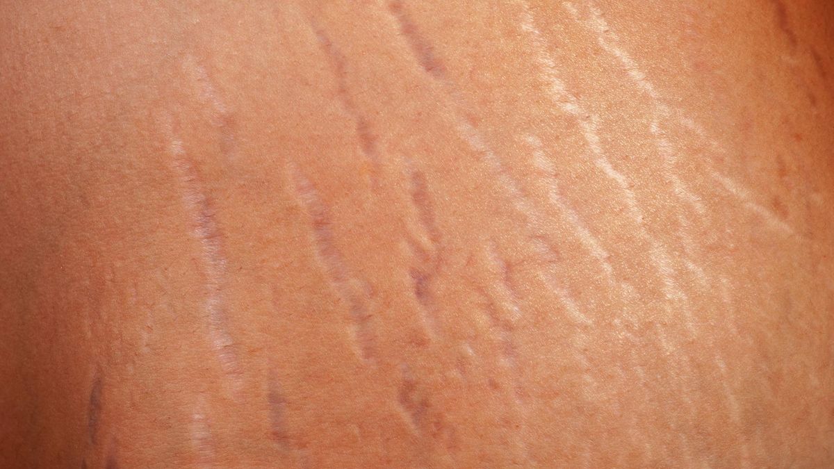 Jak nie dopuścić do pojawienia się rozstępów?