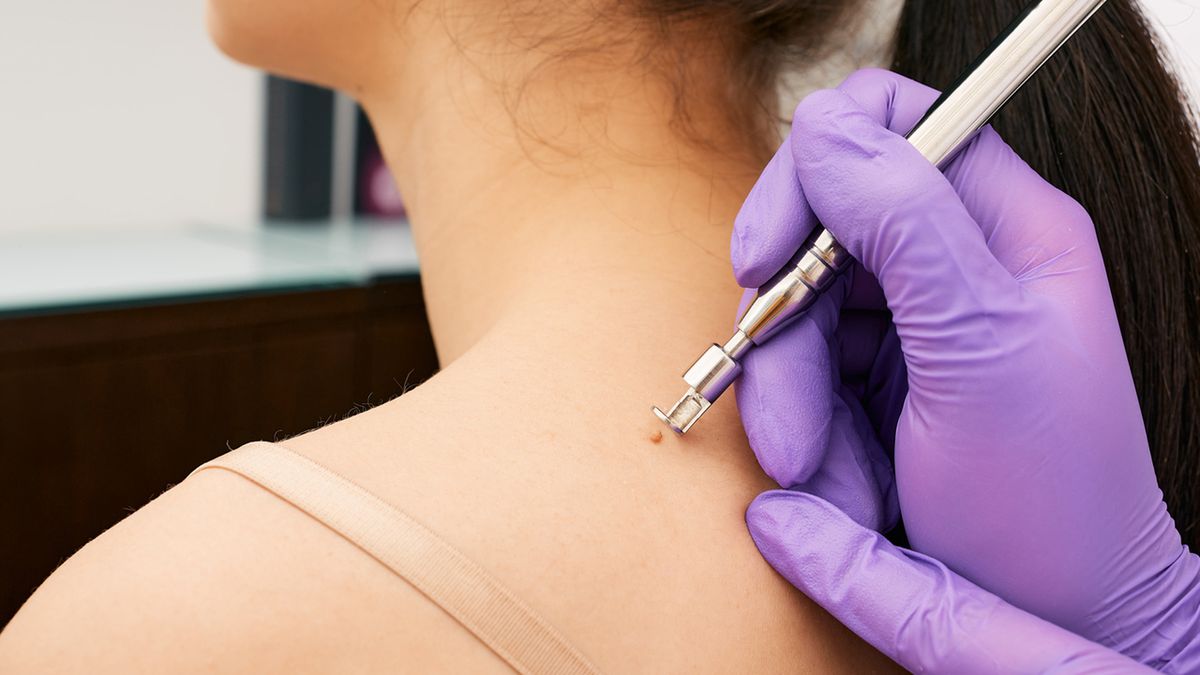 Elektrokoagulacja to zabieg wykorzystywany do usuwania zmian skórnych.