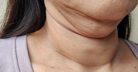 Pierwsze objawy przypominają przeziębienie. W Polsce nowotwory głowy i szyi są diagnozowane za późno
