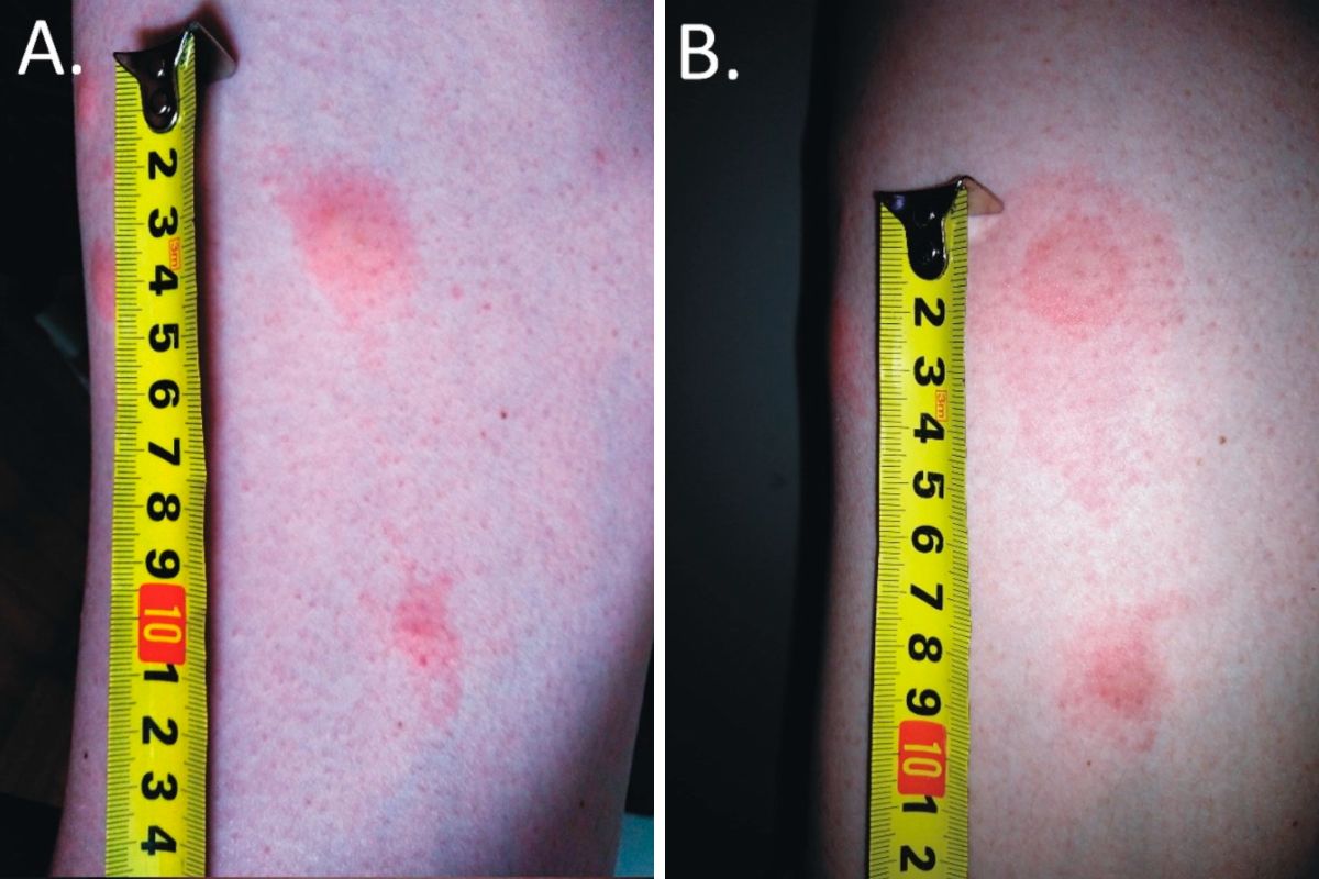 Takie zmiany mogą pojawić się na skórze po ukąszeniu przez strzyżaka