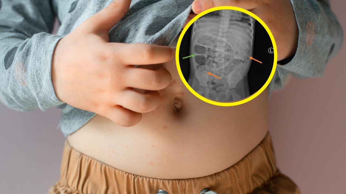 Dziecko skarżyło się na ból brzucha. W jego jelitach odkryli robaki