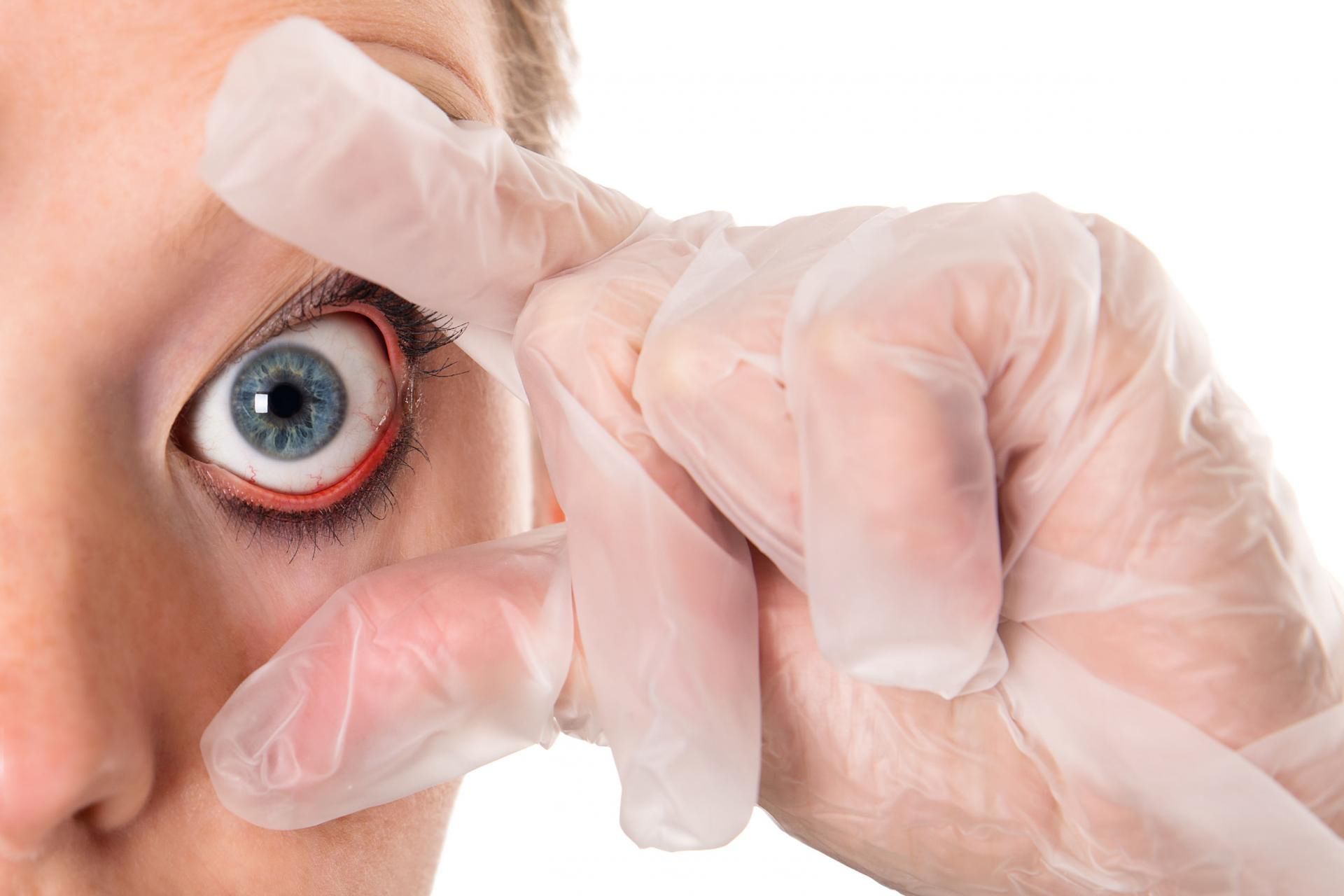 Zapalenie brzegu powiek można nabawić się przebywając często w dymie i pyle