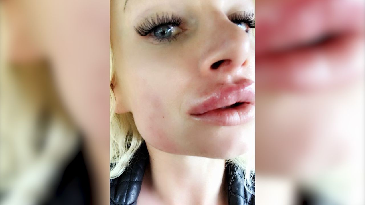 Chce wyglądać jak Barbie. Niestety powiększenie ust było nieudane (WIDEO)