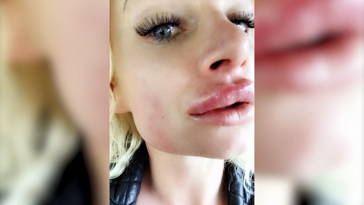 Po nieudanym powiększeniu ust konieczne było usunięcie wypełniacza